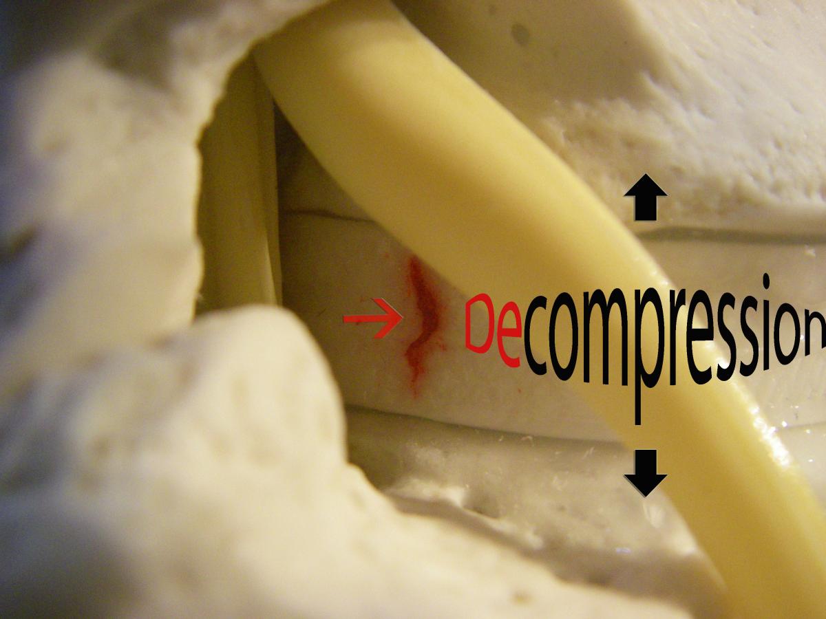 MRI assessment lumbar discs sitting and decompression exercise